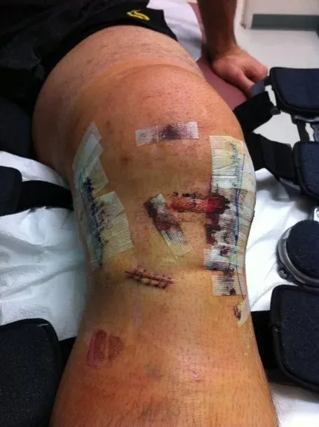 Forrest_s_knee_medium